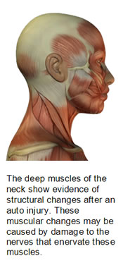 Muscle Injury After Whiplash